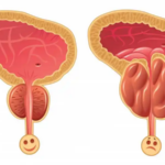 Plantele care ajută la sănătatea prostatei: Beneficii și utilizări cf-featured-37
