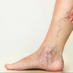 Remediu naturist pentru picioare grele: Tinctură cu castan sălbatic, viță roșie și gălbenele cf-featured-64